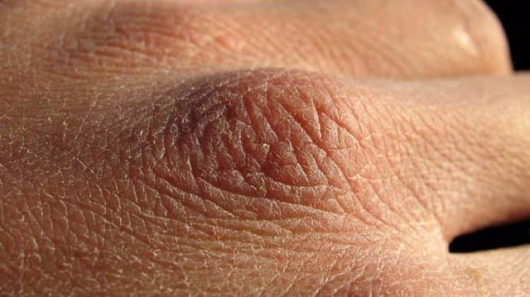 Şeker hastalığının çok bilinmeyen erken belirtileri