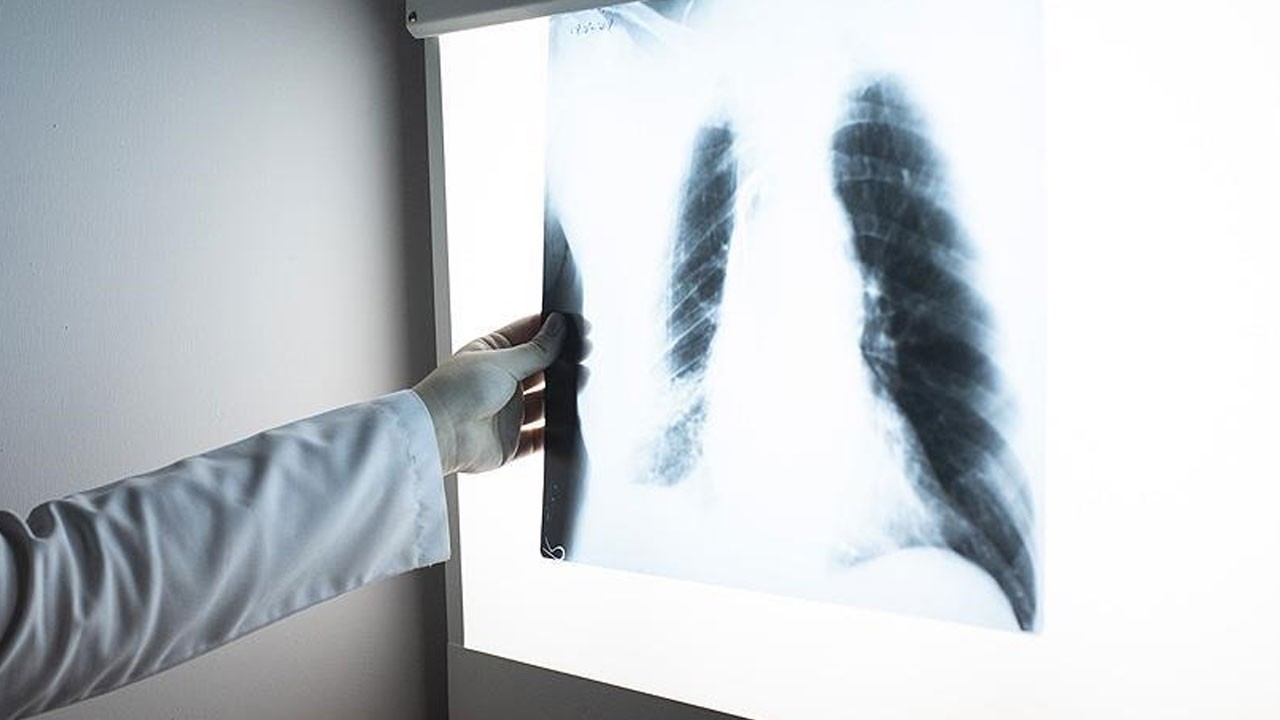 Sessiz ilerliyor, akciğeri vuruyor! Öksürükte kan varsa dikkat