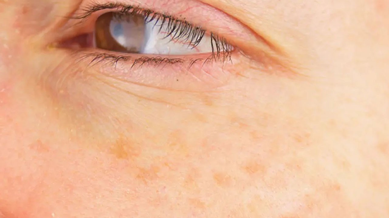 Sessiz tehdit! Bu alışkanlık cilt kanseriyle bitebilir