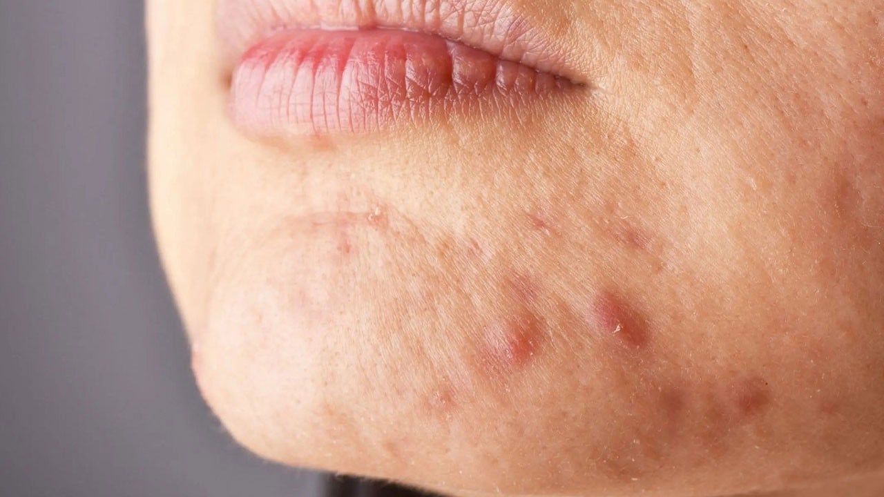 Sessiz tehdit! Güneşin zararı sadece yanıkla sınırlı değil