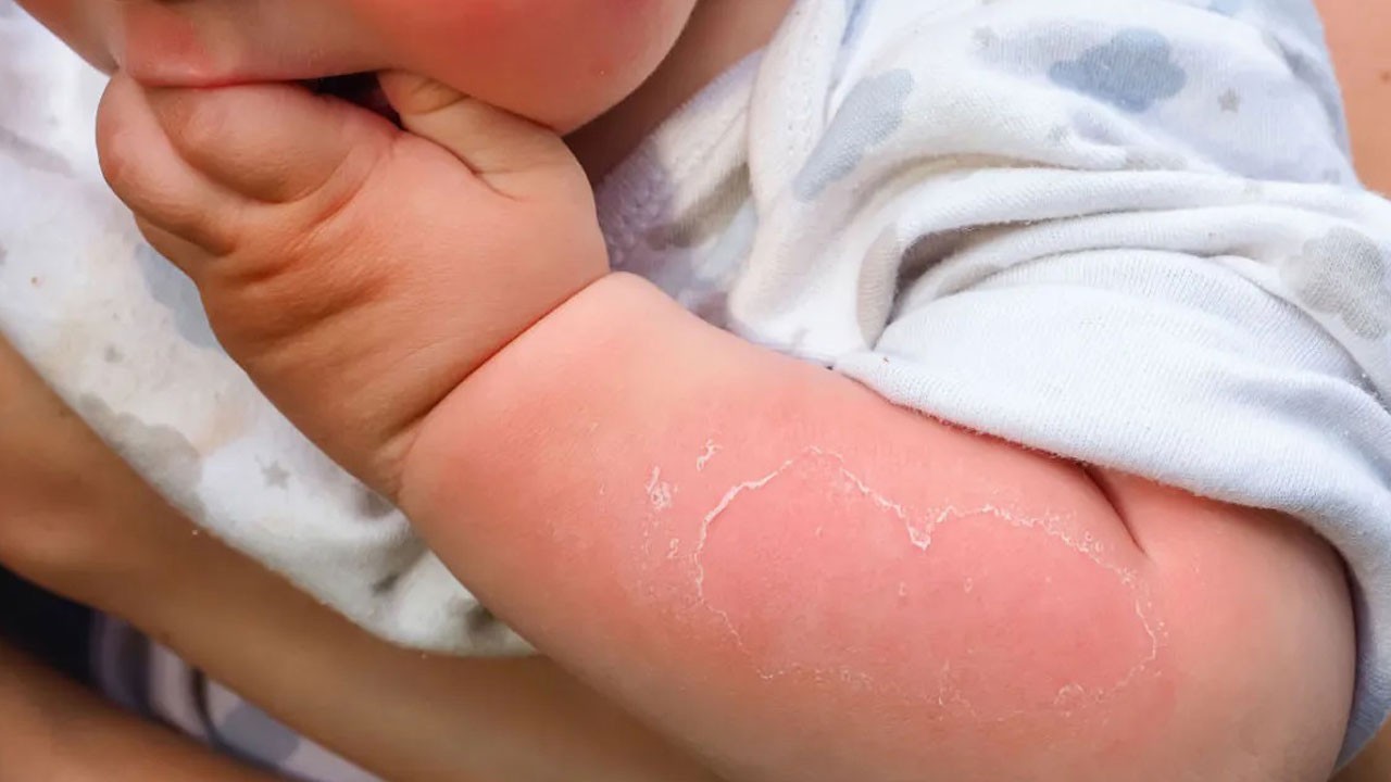 Sessiz tehlikesi! Güneşin zararı yıllar sonra ortaya çıkıyor