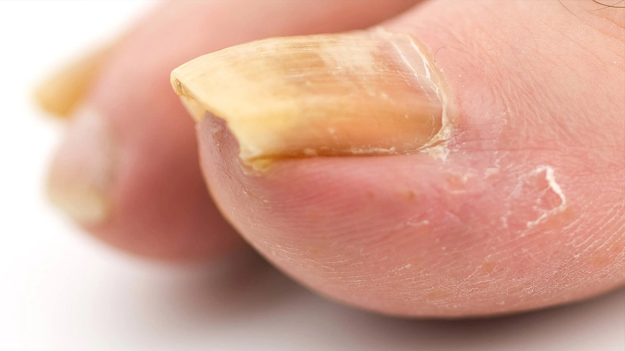 Sessiz ve gizli tehlike: Ayak tırnağınız, kötü hastalık uyarısı olabilir