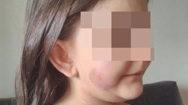 Şiddet mağduru 5 yaşındaki çocuk devlet korumasında