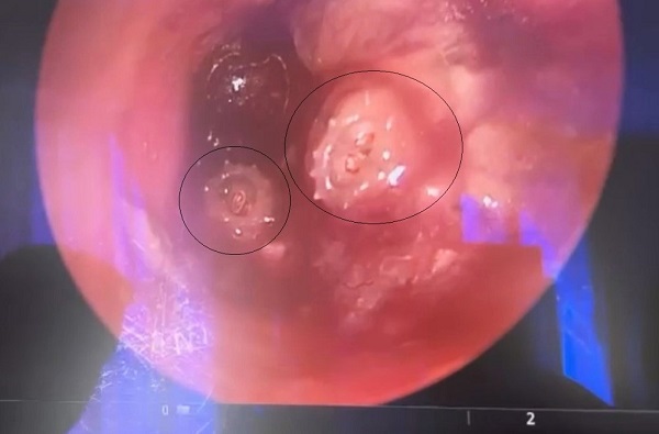 Şiddetli ağrı şikayetiyle gitti! Bakın 13 yaşındaki çocuğun kulağından ne çıktı