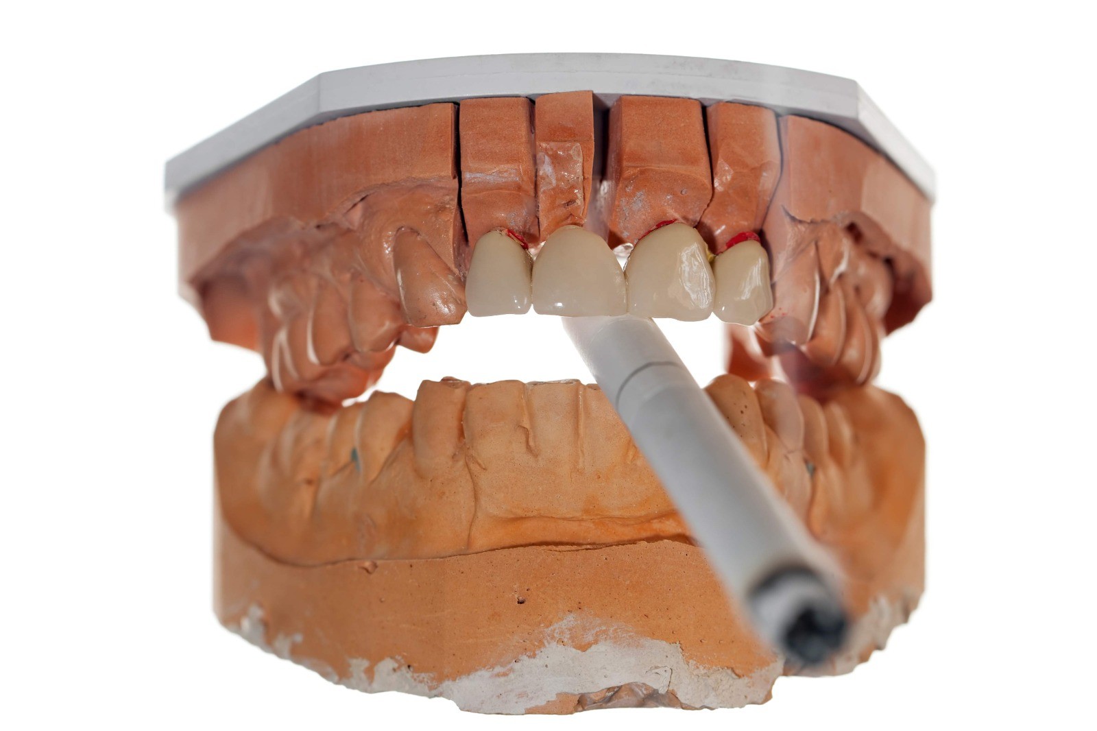 Sigara diş eti hastalıklarını şiddetlendiriyor