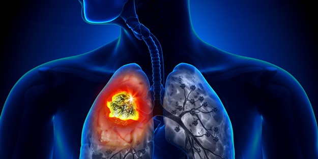 Sigara içenlerde akciğer kanseri görülme riski 36 kat artıyor