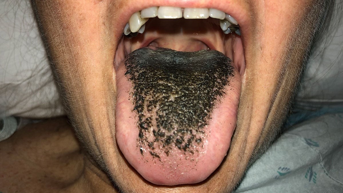 Sigara içenlerde öyle bir hastalık peyda oldu ki gören gözlerine inanamıyor! Dillerinde kıl çıkıyor! "Kıllı dil" kâbusuna karşı bunları yapın