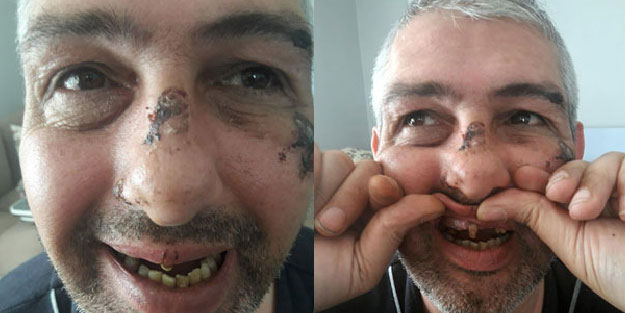 Sigara ve bisiklet için dişlerini döktüler!