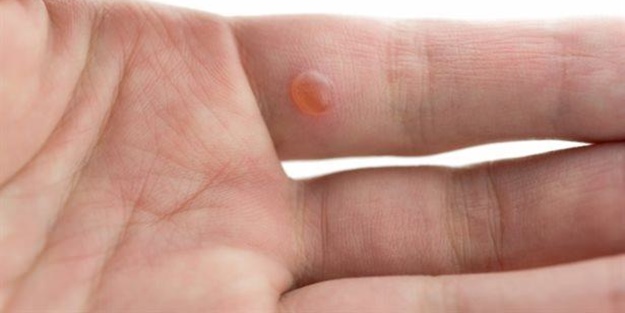 Siğilin tedavisi var mı?