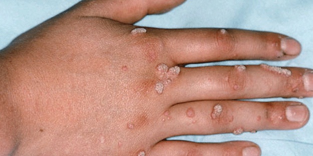 Siğillerin üzerine muz kabuğu koyarsanız...