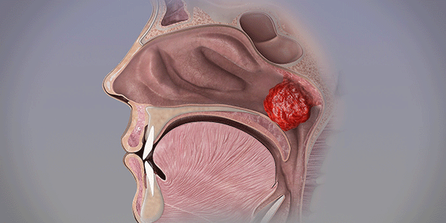 Sık sık şişerek nefes darlığına yol açıyor Geniz eti ne zaman alınmalı?