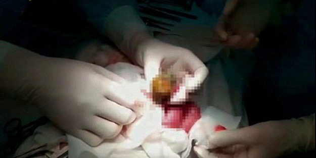 Sinirlenince bunu yapıyordu, bağırsağından çıkarıldı