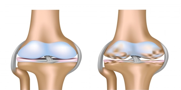  Sınırlı (Fokal) kıkırdak hasarları nasıl olur?