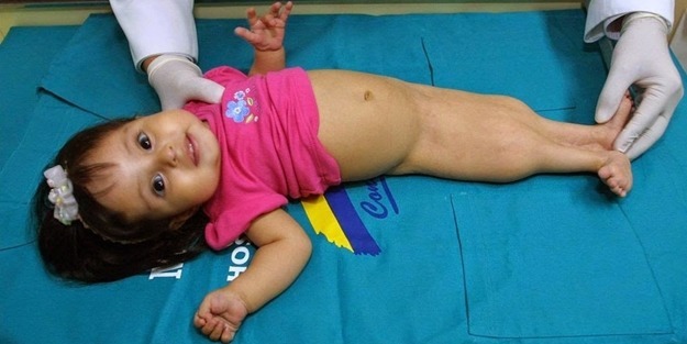 Sirenomelia hastalığı nedir? Tedavisi nelerdir?