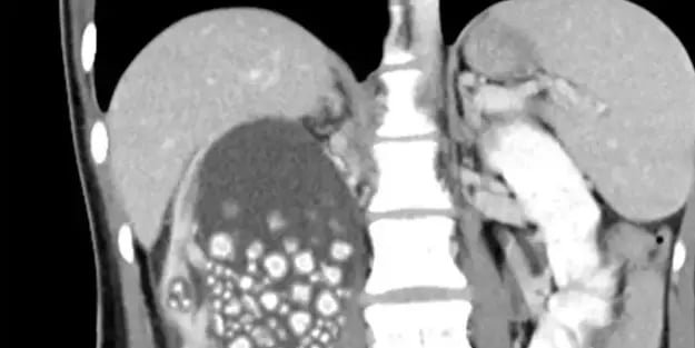 Sırt ağrısı şikayetiyle hastaneye başvurdu! Tayvan'da akılalmaz olay! 300’den fazla böbrek taşı çıkarıldı!