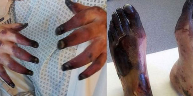 Sistemik skleroz hastalığına dikkat! El ve ayak parmakları kesildi