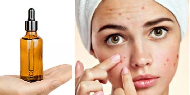 Sivilce için en iyi esansiyel yağlar