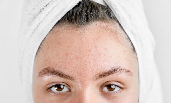 Sivilce sorunu yaşayanlar ne yemeli ne içmeli?