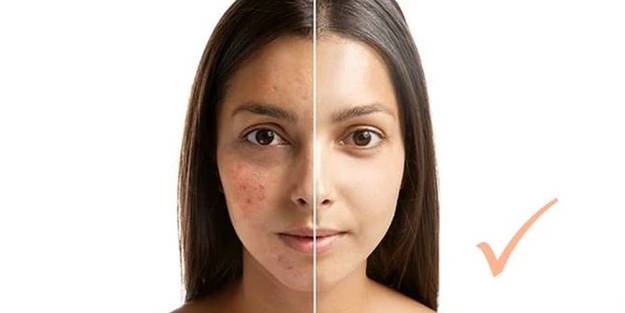 Akneli yüz haritası: Sivilceler sağlığınız hakkında çok şey söylüyor