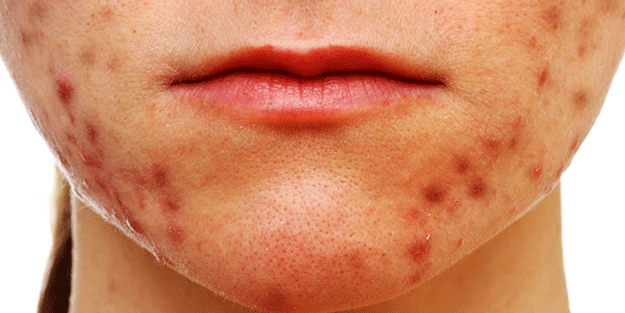 Sivilceleri azaltan10 yiyecek