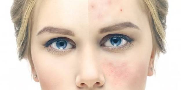 Sivilceleri yok eden doğal yöntemler