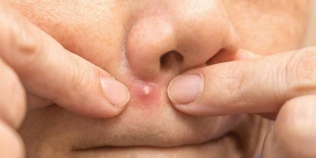 Sivilcesini patlattı! Beyni iltihapla doldu