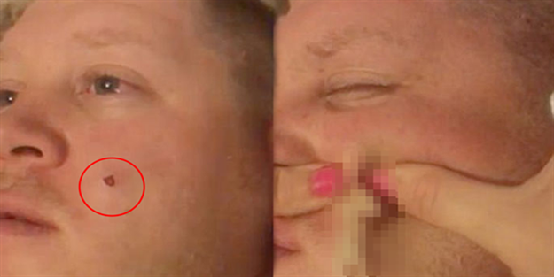 Sivilcesini sıkınca çıkanlar şok etti!