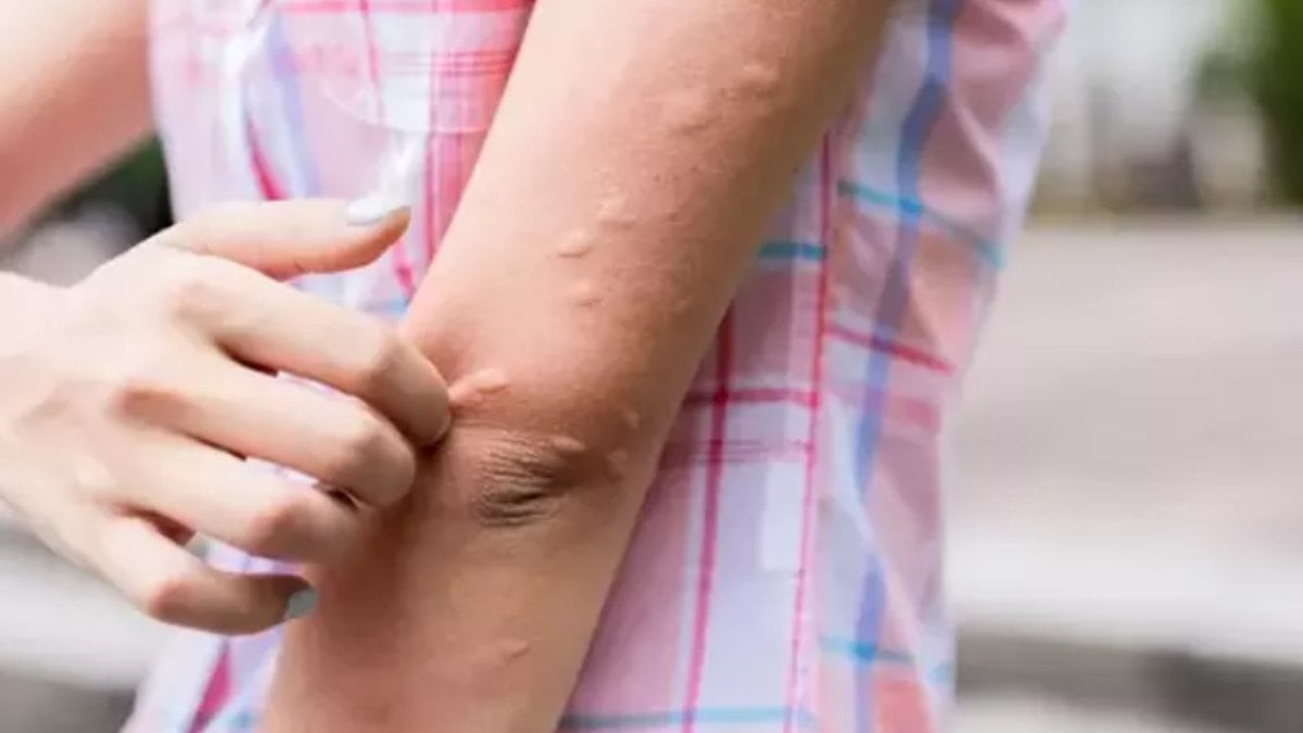 Sivrisinek ısırığı artık kabusunuz olmayacak! Şakkadanak kesip atıyor! Bunu yapın, 