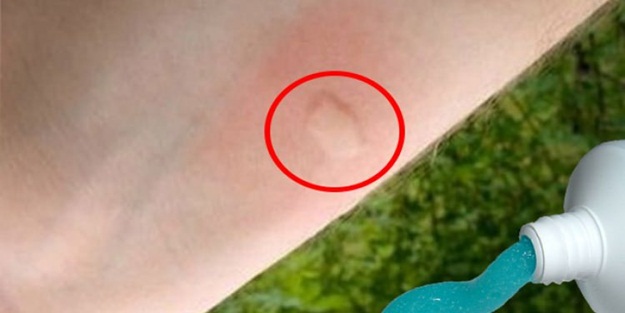 Sivrisinek ısırığına ne iyi gelir?