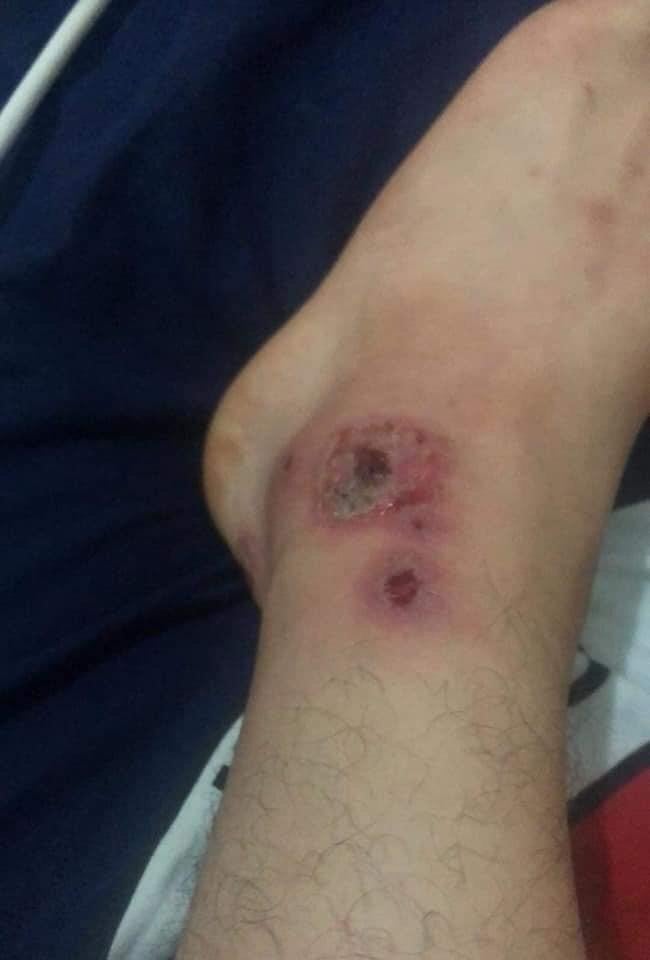 Sivrisineklerin ısırdığı vatandaş, yaraları sebebiyle evinden çıkamıyor 