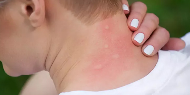 Sivrisinekten nasıl korunulur? Sağlık Bakanlığı'ndan korunma rehberi