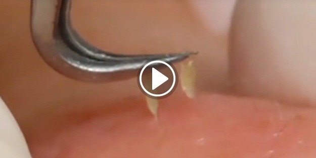 Siyah nokta temizleme