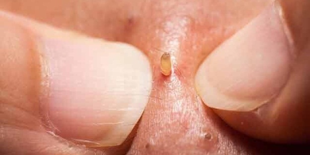 Siyah noktalarını sıkanlar dikkat!