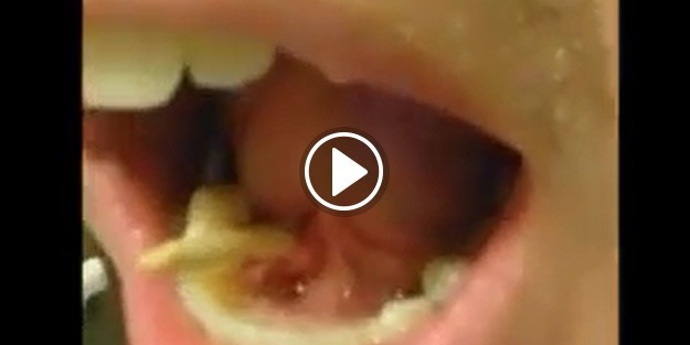 Sizin ağzınızda da olabilir! Korkunç görüntü...