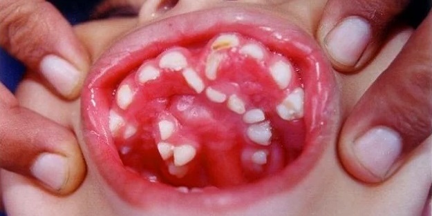 Sizin de damağınızda gizli dişler olabilir!