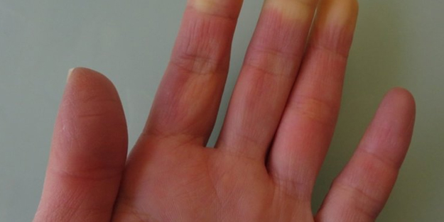 Skleroderma nedir? El ve ayaklarda bu belirtiye dikkat! Erken tanı büyük önem taşıyor