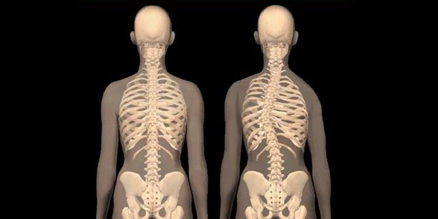 Skolyoz nedir?
