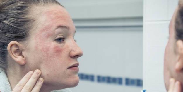 Soğuk hava bazı egzama türlerini tetikliyor! Egzama nedir, neden olur, belirtileri ve tedavisi