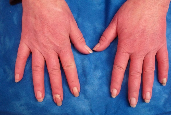 Soğuk havalarda şikayetler artıyor! Bu hastalığın sebebi bilinmiyor