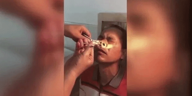 Şoke eden olay! Kanayan burnundan çıkanlar şaşkına çevirdi