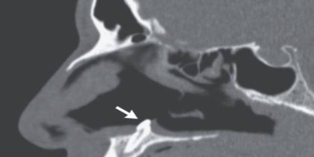 Solunum problemi çekiyordu! Bakın burnundan ne çıktı