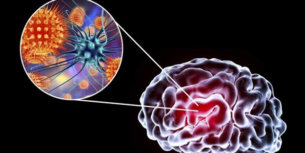 SSPE hastalığı nedir? SSPE hastalığı nedenleri, belirtileri ve tedavisi…