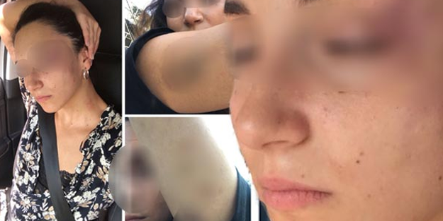 Stajyer avukata yalıda dayak şoku! Suratını ısırdı