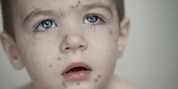 Su çiçeği sonrası o sendroma dikkat!