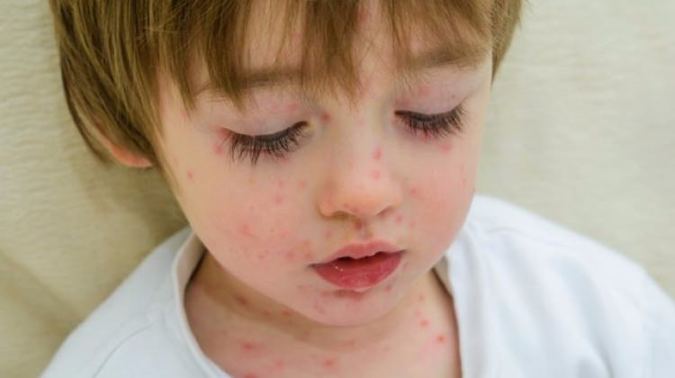 Suçiçeği belirtileri nelerdir?