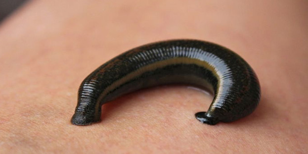 Sülük tedavisi canından ediyordu! Yürümekte zorluk çekiyor!