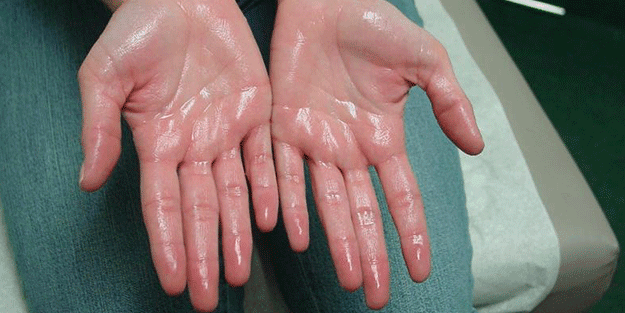 Sürekli eli terleyenler dikkat! Bakın neye işaret ediyor