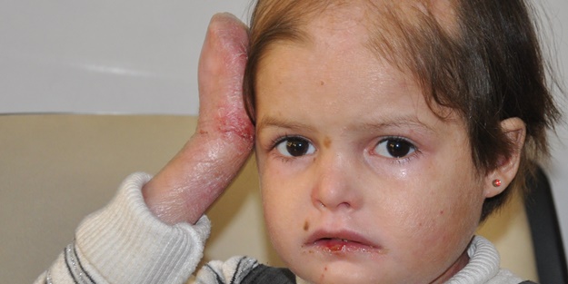 Suriyeli küçük kız şifa bekliyor