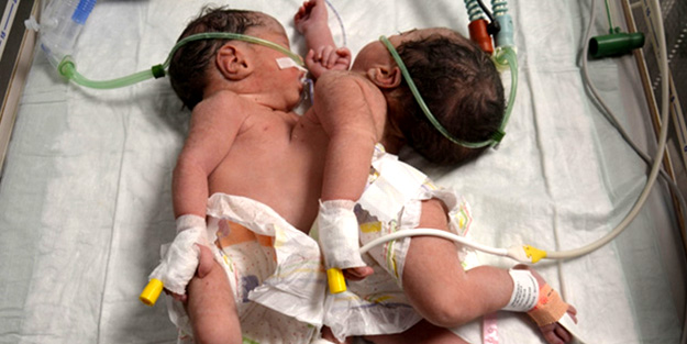 Suriyeli siyam ikizlerinden kötü haber!