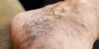 Süt ile varis tedavisi dikkat çekti! kadın ve erkek bu karışımı bulan kaçırmıyor! Kaçıran ise bin pişman!